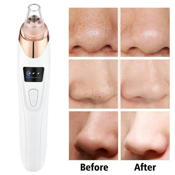 5-in-1 Blackhead & Acne Remover Vacuum