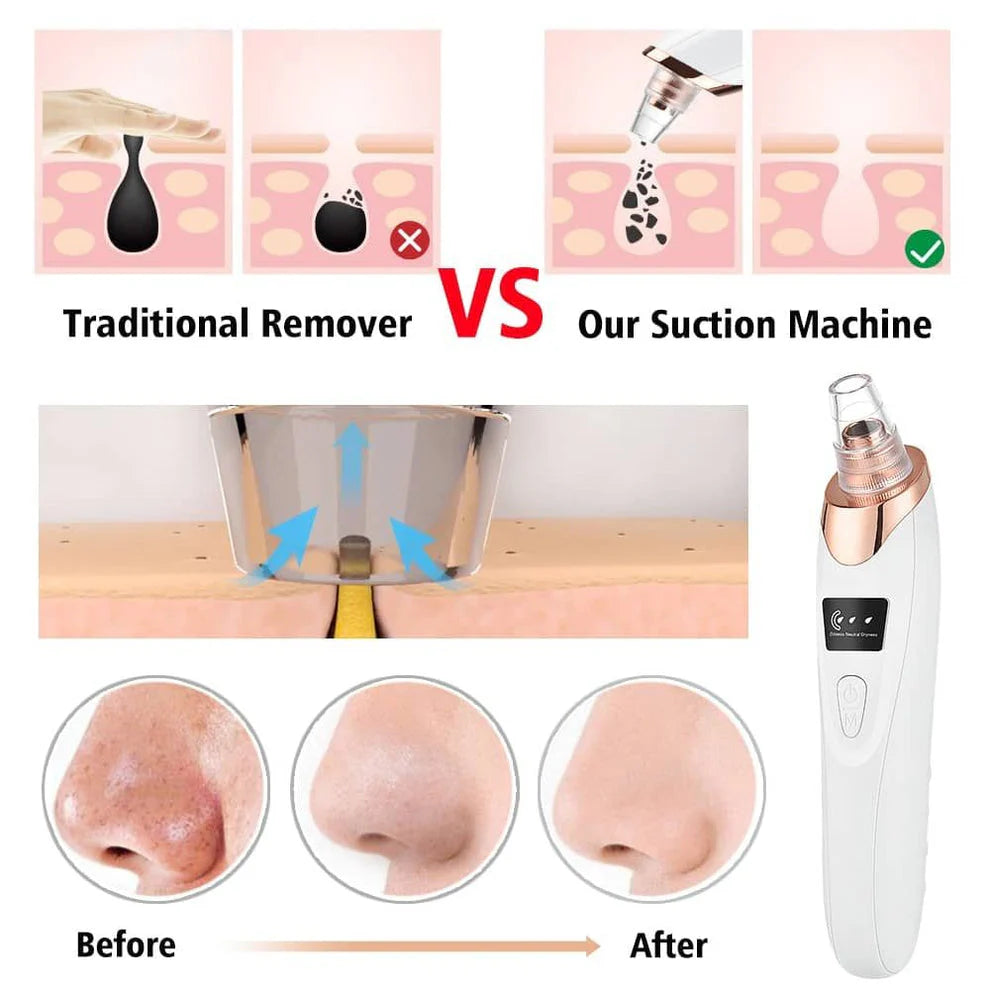 5-in-1 Blackhead & Acne Remover Vacuum